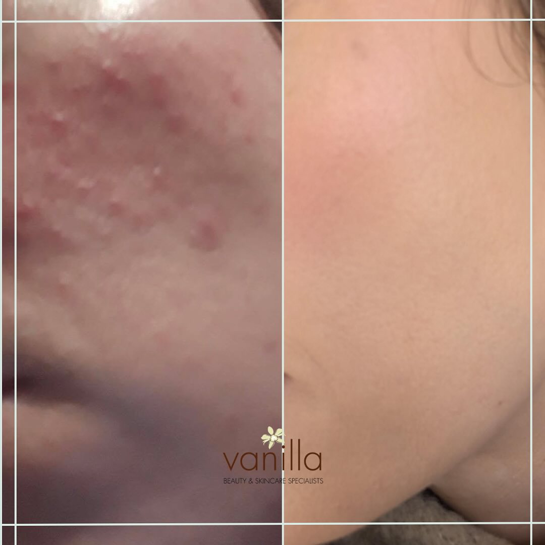 Hannah contacted us last year asking if we could help her with her skin after following us for a while on social media. She had been given a cream to treat her rosacea from the doctors which she had been using for YEARS and not really getting results.
After a thorough consultation we decided to opt for a vitamin a cream to strengthen and repair the skin alongside a probiotic called Skin Clear Biome with added power to treat the inflammation from the inside out.
As you can see her transformation has been incredible. Hannah has told me that she has also been receiving compliments about great her skin looks, which is just amazing! 🤩
Ready to get better results from your skin routine?
Comment ‘skin’ if you would like us to get in touch with ways that we can help you.
#skincliniccumbria #skintreatmentscumbria #skintreatmentslancashire #beautysaloncumbria #beautysalonlakedistrict #southlakes #kendalcumbria #lancashire