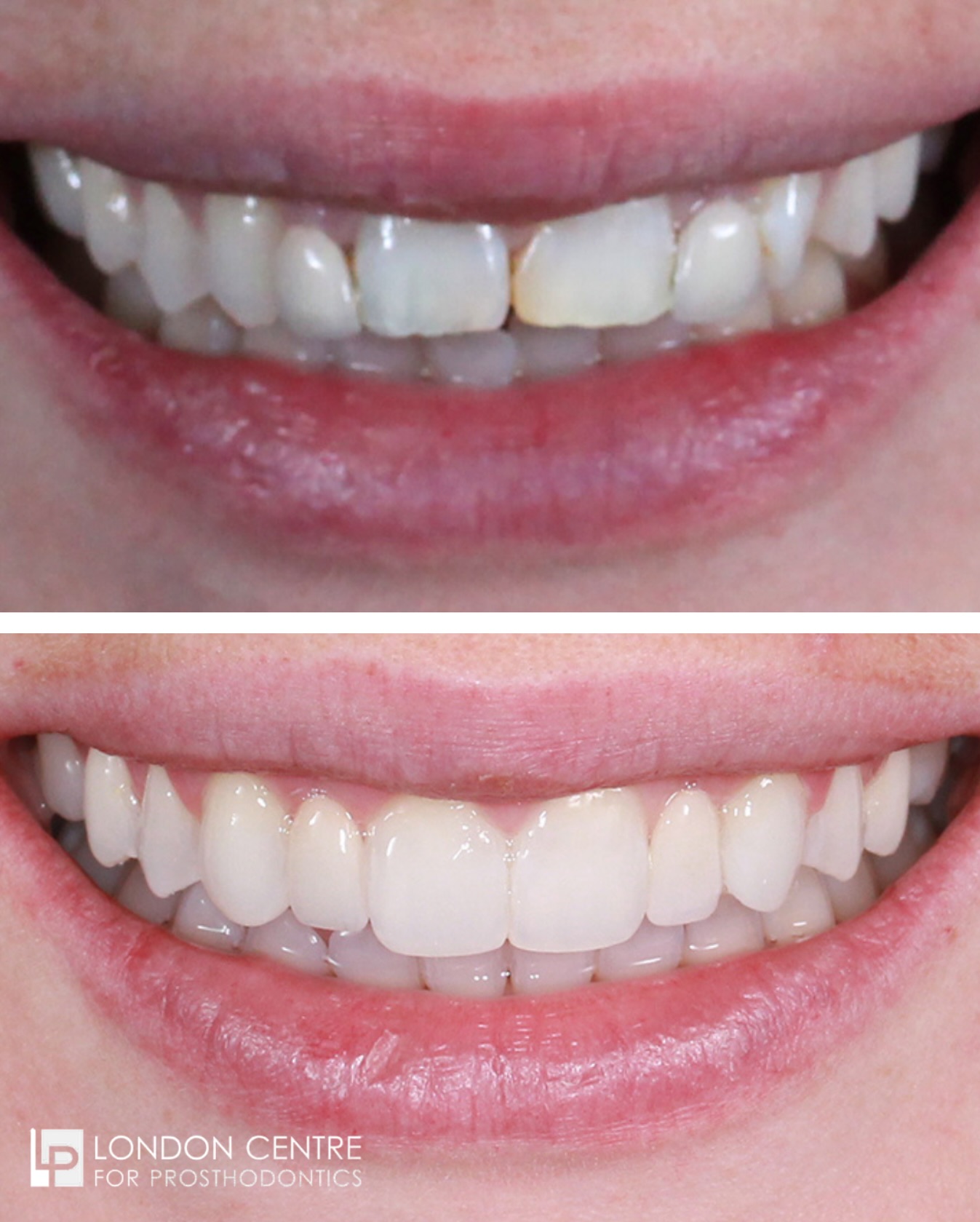 Patients come to see us with a whole host of problems. The solution may be simple, like replacing a filling but we also successfully treat patients with complex dental problems.
This patient was unhappy with her smile. She did not like the alignment and lack of uniformity with the shapes and contours of her teeth. Her upper lateral incisor teeth never formed and they were being replaced with poorly shaped and positioned adhesive bridges that made her smile even worse. She also has a huge discrepancy between the positions of her upper and lower teeth which we call increased overjet.
After detailed multidisciplinary planning, @dremmalaing set up her case with excellent orthodontic treatment. @kavitnshah completed the treatment and created the beautiful smile she was looking for with Tooth whitening using @enlightensmiles, subtle composite bonding using @gcunitedkingdom Essensia multilayered composite and replacement of the missing lateral incisors with ceramic adhesive bridges expertly crafted by @richart.ds
Complex cases need collaboration and team work. We work with the best to make sure you get the best results 👏
Get in touch with our team to book your appointment - we look forward to seeing you soon!
The London Centre For Prosthodontics
29 Weymouth Street
London, W1G 7DB
020 7637 4518
info@londonprosthodontics.com
Monday - Friday: 7:30am - 4:30pm
#MaryleboneDentist #LondonSmiles #HealthyTeethMarylebone #DentalCareLondon #SmileMakeover #MaryleboneOralHealth #LondonDentalExperts #CosmeticDentistry #TeethWhiteningMarylebone #EmergencyDentistLondon #MaryleboneOrthodontics #LondonDentalClinic #DentalCheckup #MaryleboneDentalCare #SmileTransformation
#LondonOralCare #MaryleboneDentalHealth #FamilyDentistLondon #TeethCleaningMarylebone #CosmeticDentistLondon #MaryleboneTeeth #LondonDentalHygiene#MaryleboneOrthodontist #OralWellnessLondon #PreventiveDentistry #MaryleboneDentalServices #LondonDentalSpecialists #MaryleboneHealthySmiles #LondonDentistry #AdvancedDentalCare